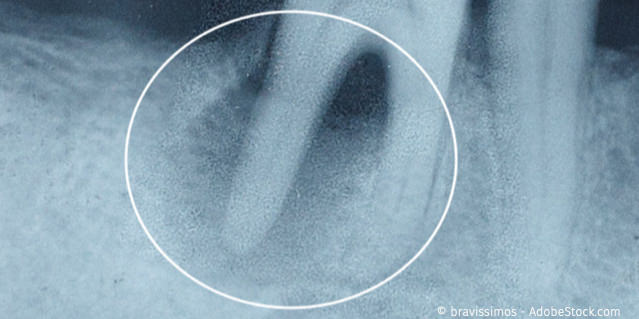 Warum müssen tote Zähne behandelt werden?